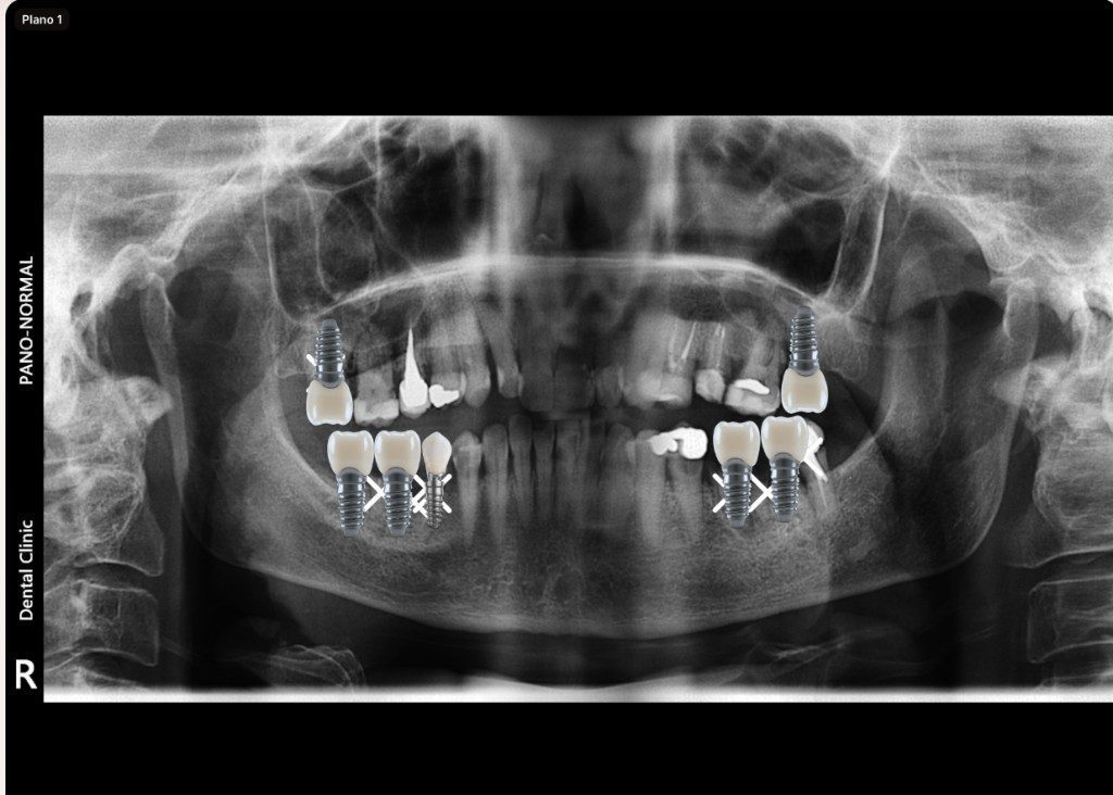 Interface do Trace Case com radiografia anotada, implantes e rótulos
